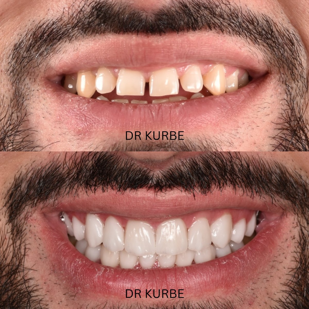 Hollywood Smile before and after results at Dr Kurbe clinic – improved teeth alignment and color