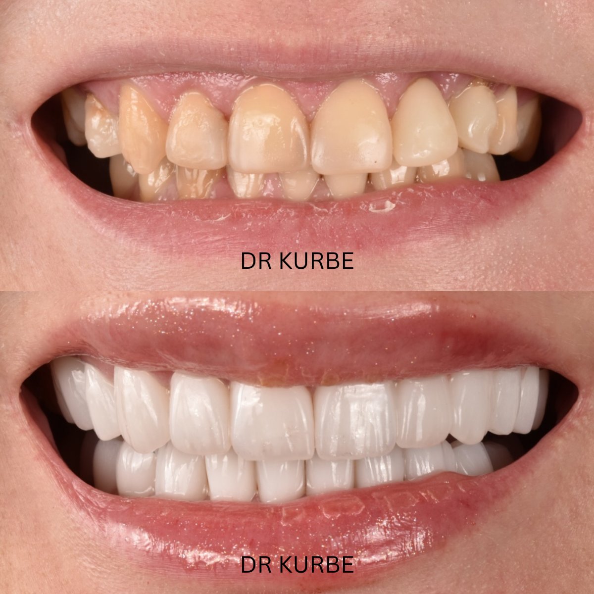 Hollywood Smile before and after results at Dr Kurbe clinic – dental veneers transformation
