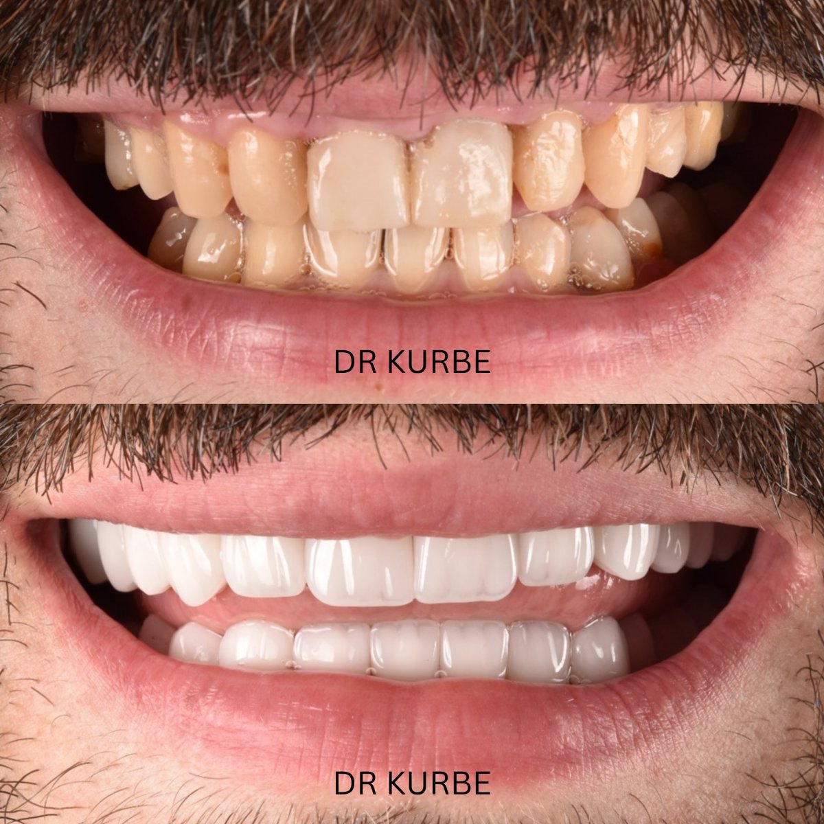 نتائج قبل وبعد ابتسامة هوليود في عيادة Dr Kurbe – تحول القشور الخزفية