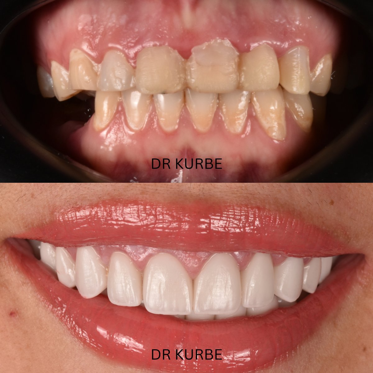 Resultados antes y después de Hollywood Smile en Dr Kurbe – transformación con carillas dentales