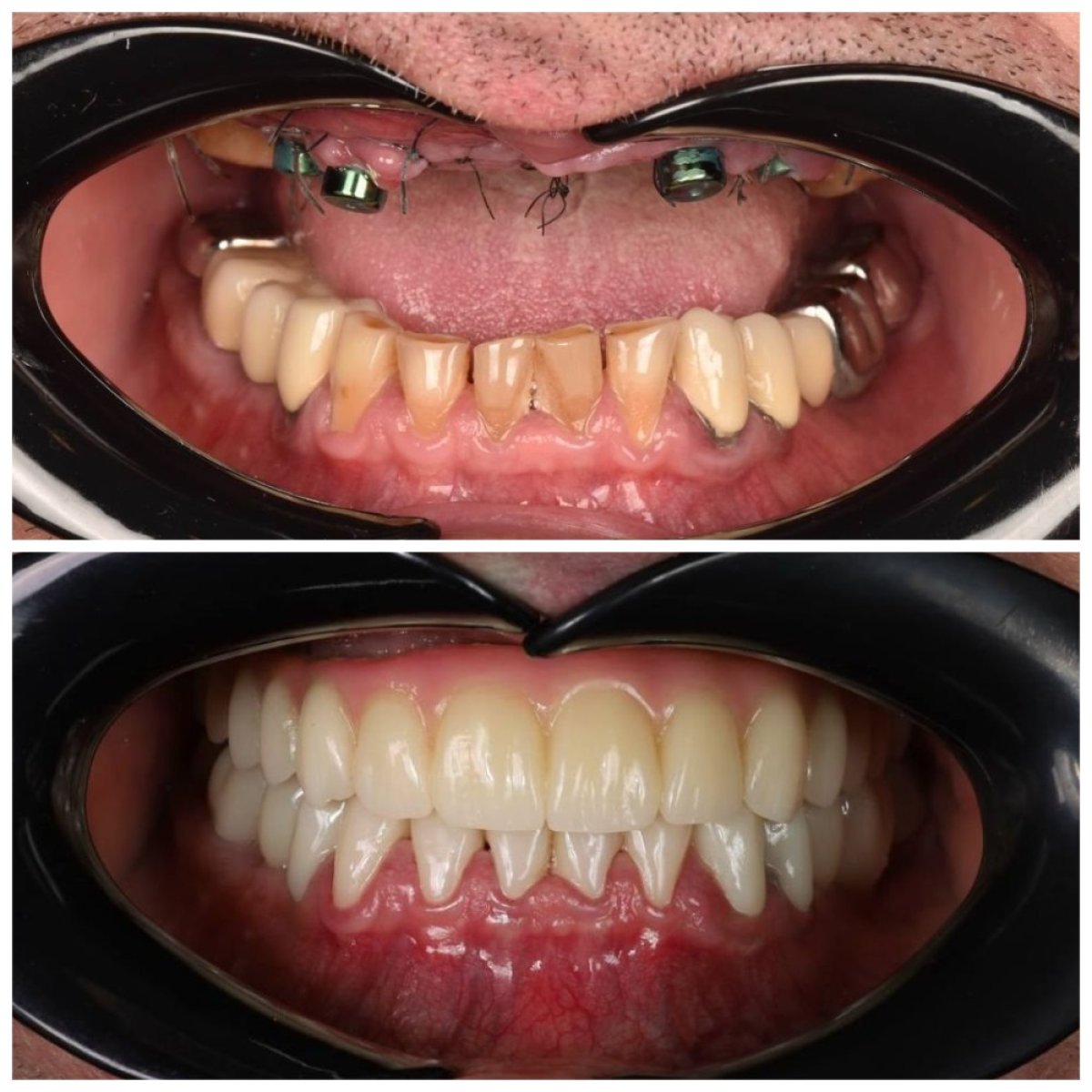 Before and after All-on-4 dental implants result at Dental Clinic Dynasty Stomatology Krakow