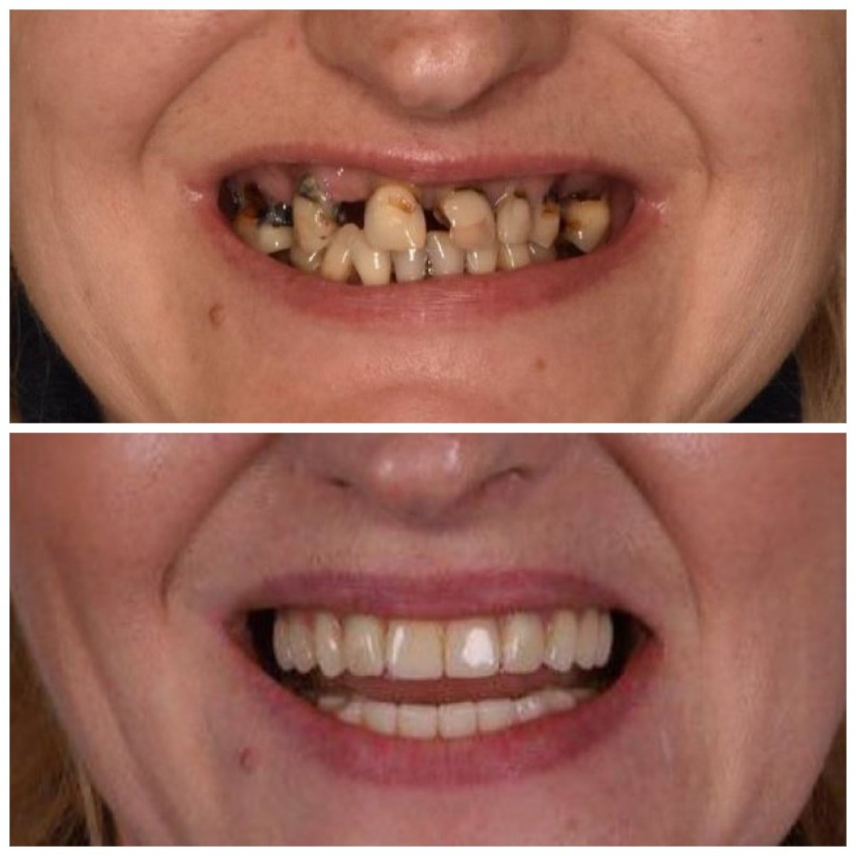 Before and after dental implant results at Dental Clinic Dynasty Stomatology in Krakow