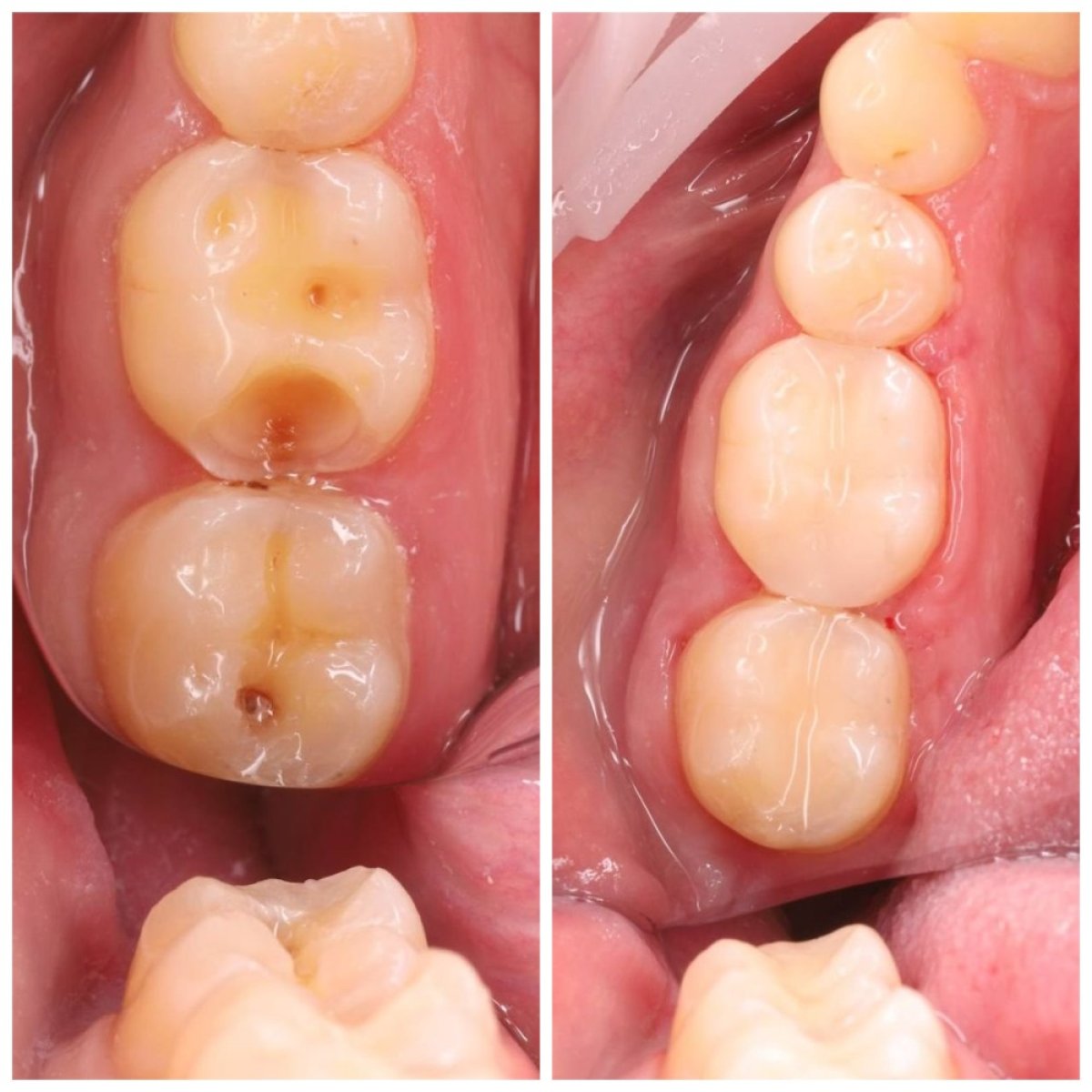 Результати до і після реставрації зубів у Dental Clinic Dynasty Stomatology у Кракові