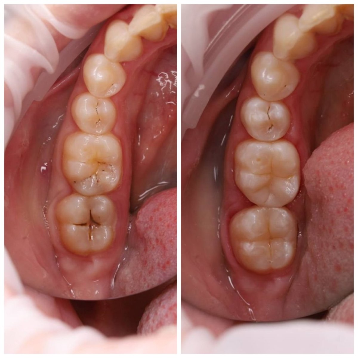 نتائج قبل وبعد ترابط الأسنان في عيادة Dynasty Stomatology في كراكوف
