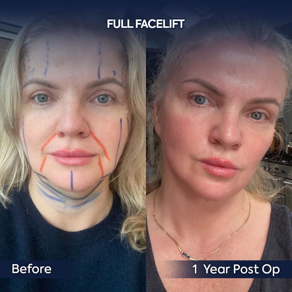 Before and after full facelift results at Dr. Safa Manav Clinic, visible facial rejuvenation