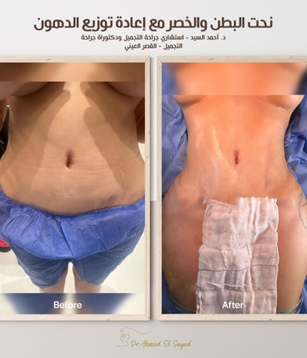 Before and after tummy tuck and liposuction results by Dr. Ahmed El Sayed – flatter abdomen