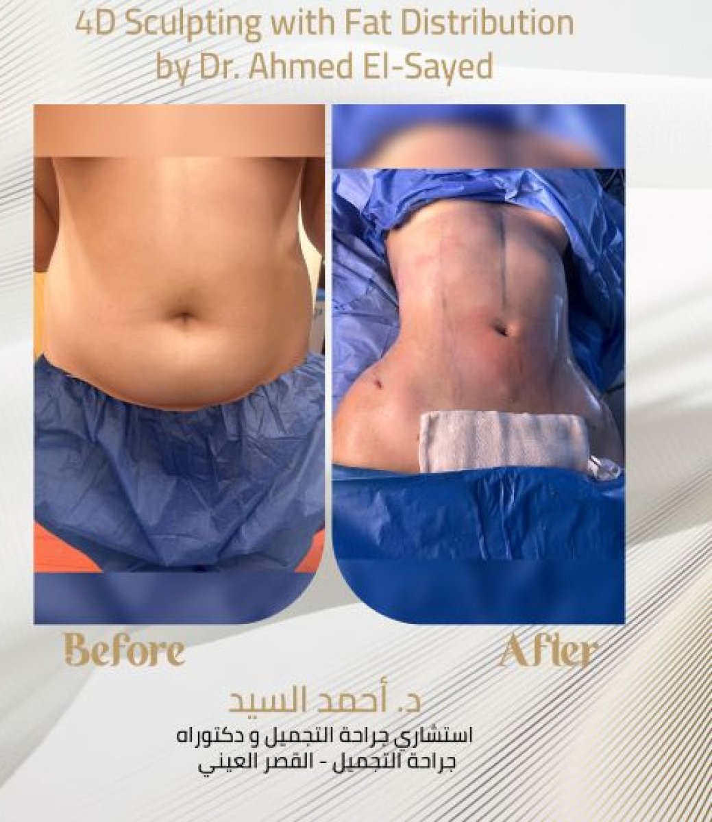 Before and after 4D sculpting with fat distribution by Dr. Ahmed El-Sayed, tummy tuck result