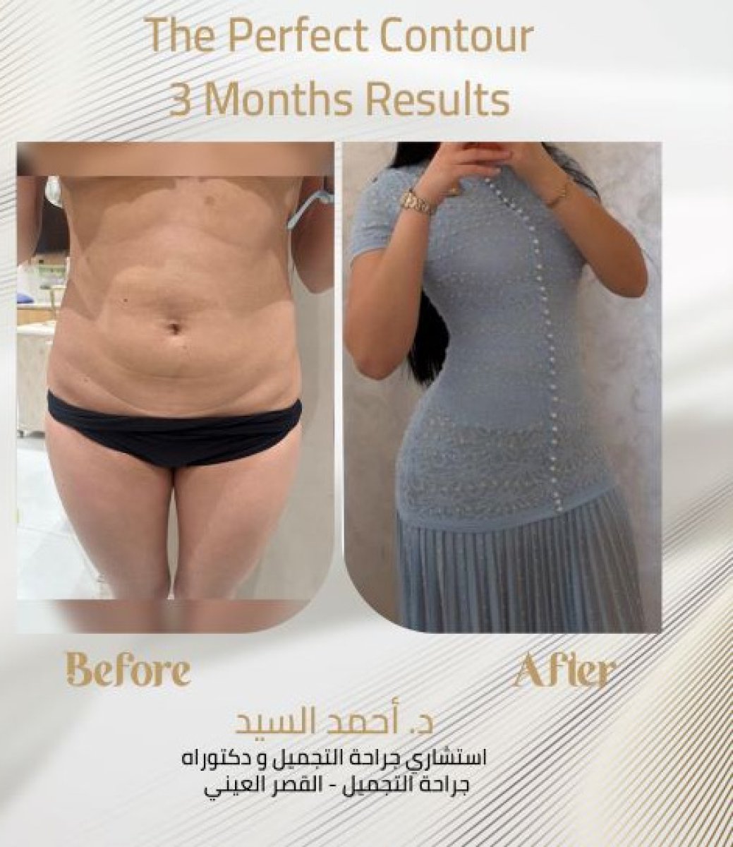 Tummy tuck before and after results, visible body contouring improvement after 3 months