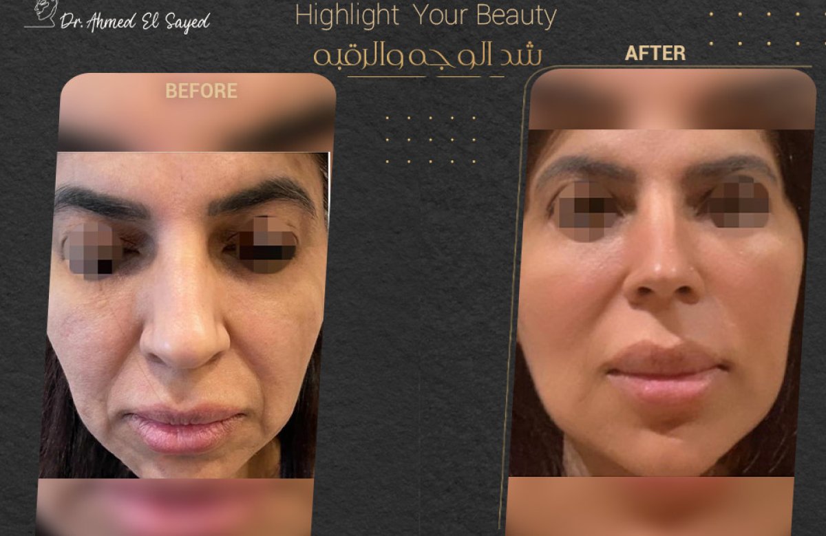 Facelift before and after results at Dr. Ahmed El Sayed clinic – visible facial rejuvenation