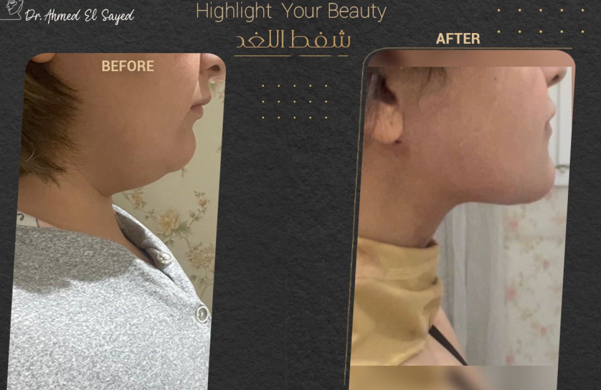 Before and after double chin liposuction results at Dr. Ahmed El Sayed clinic, improved jawline