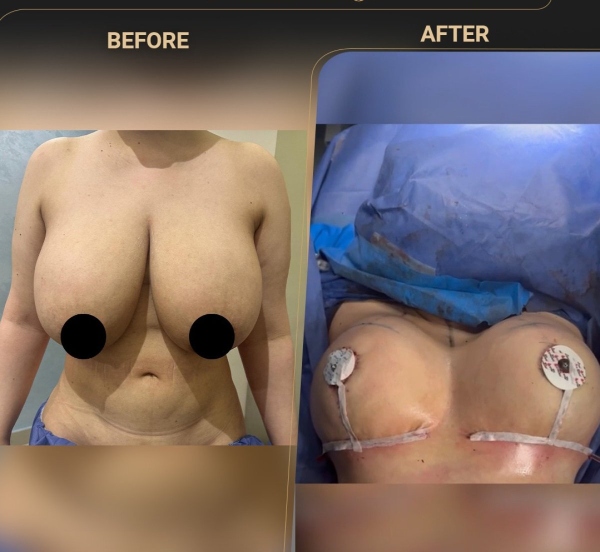 Résultats avant/après lifting mammaire – amélioration visible du galbe après chirurgie