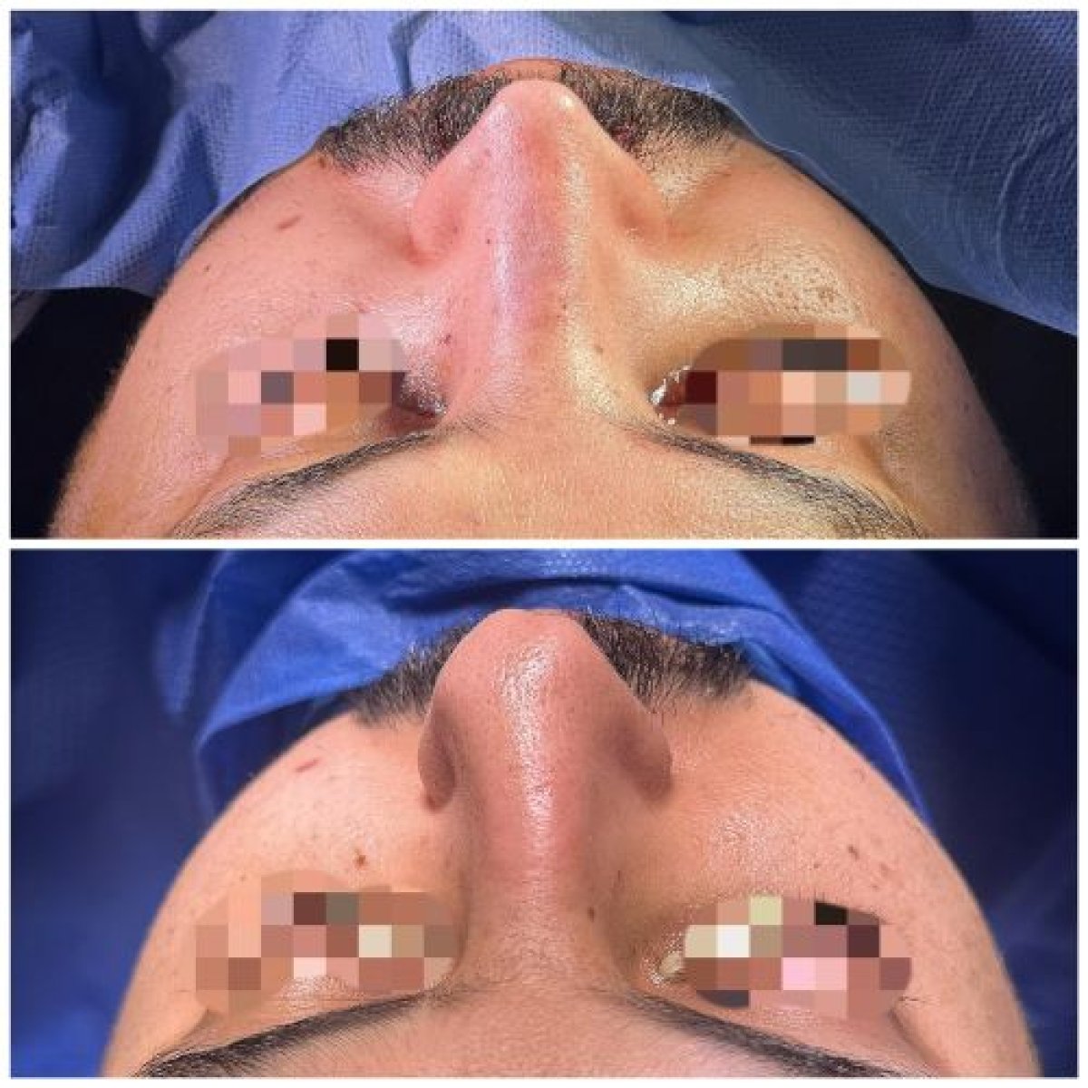 نتائج تجميل الأنف قبل وبعد، تحسين شكل وتناسق الأنف لمريض ذكر
