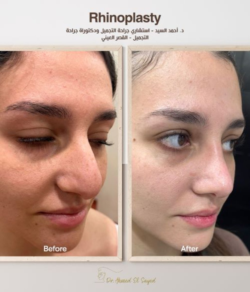 Before and after rhinoplasty results by Dr. Ahmed El Sayed – nose reshaping improvement