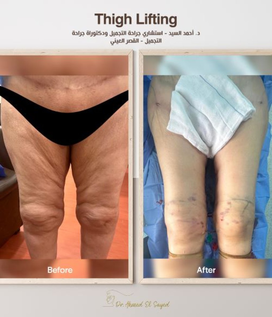 Resultados antes y después de lifting de muslos, piel más firme y mejor contorno