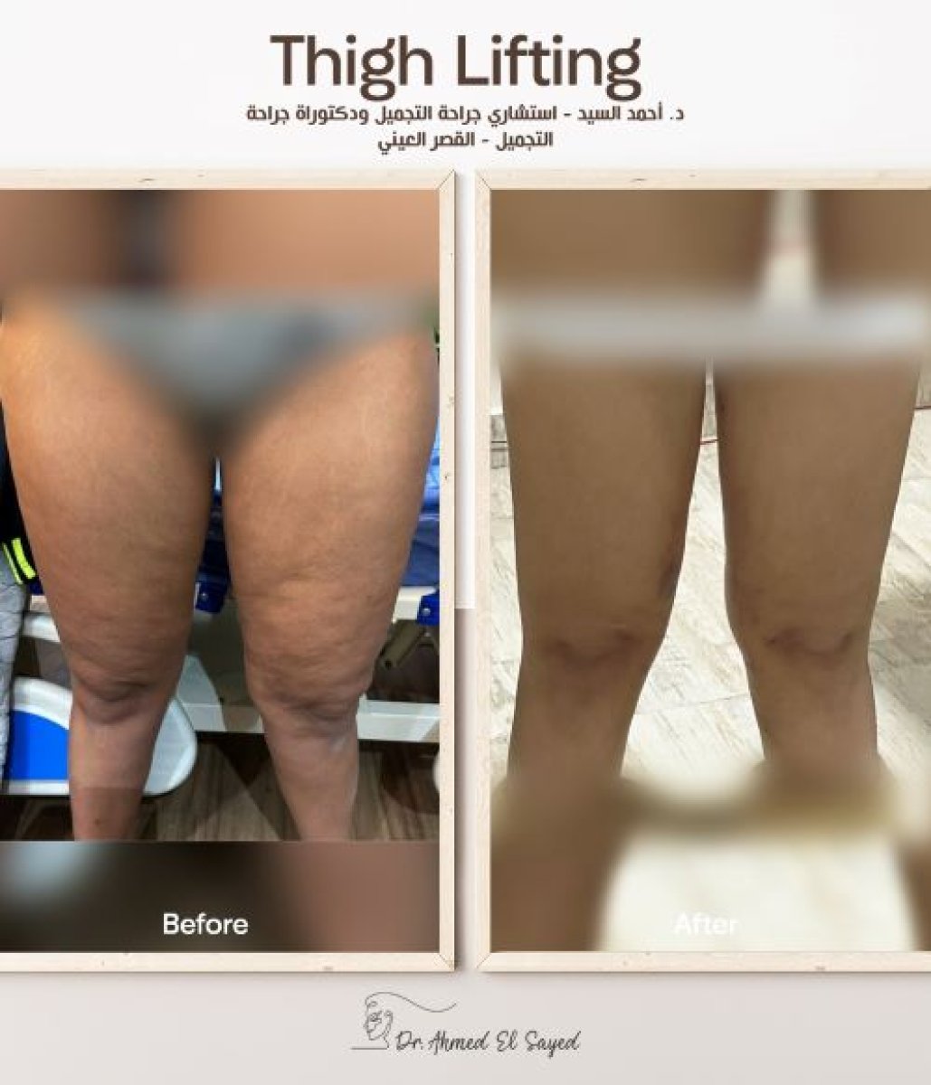 Before and after thigh lift results by Dr. Ahmed El Sayed – improved thigh contour