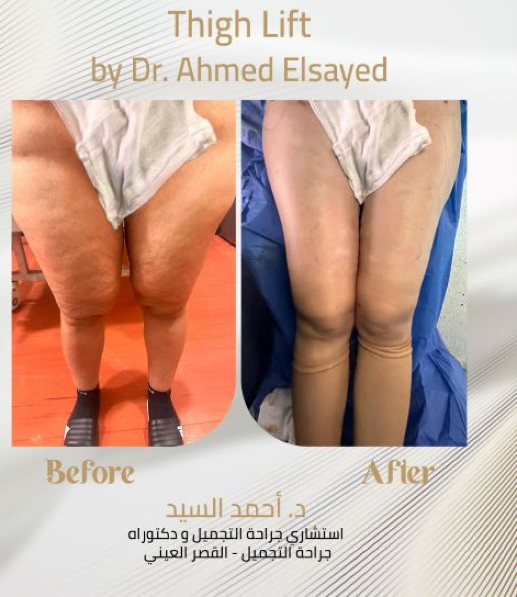 Before and after thigh lift results by Dr. Ahmed Elsayed – smoother, slimmer thighs
