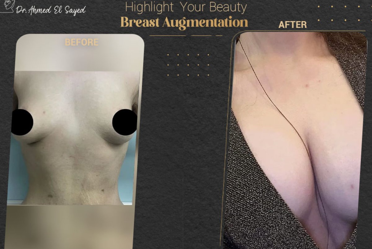Before and after breast augmentation results by Dr. Ahmed El Sayed – enhanced breast shape