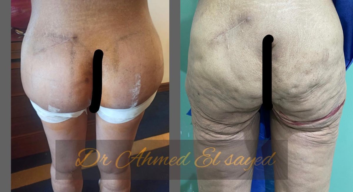 نتائج قبل وبعد عملية Brazilian Butt Lift مع د. أحمد السيد، تحسين شكل الأرداف