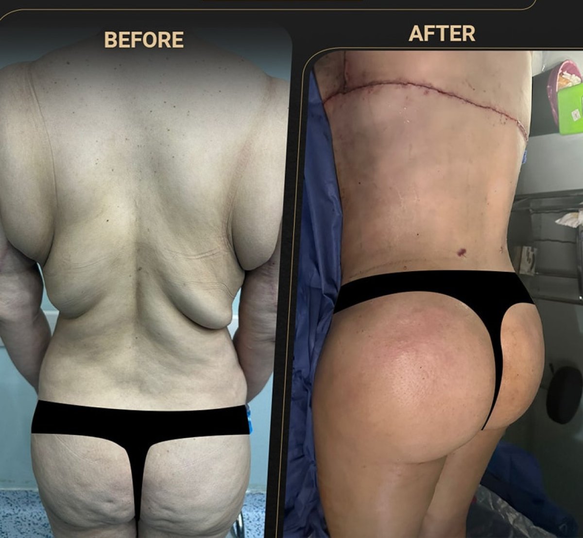 نتائج قبل وبعد عملية Brazilian Butt Lift – تحسين شكل الأرداف والجسم
