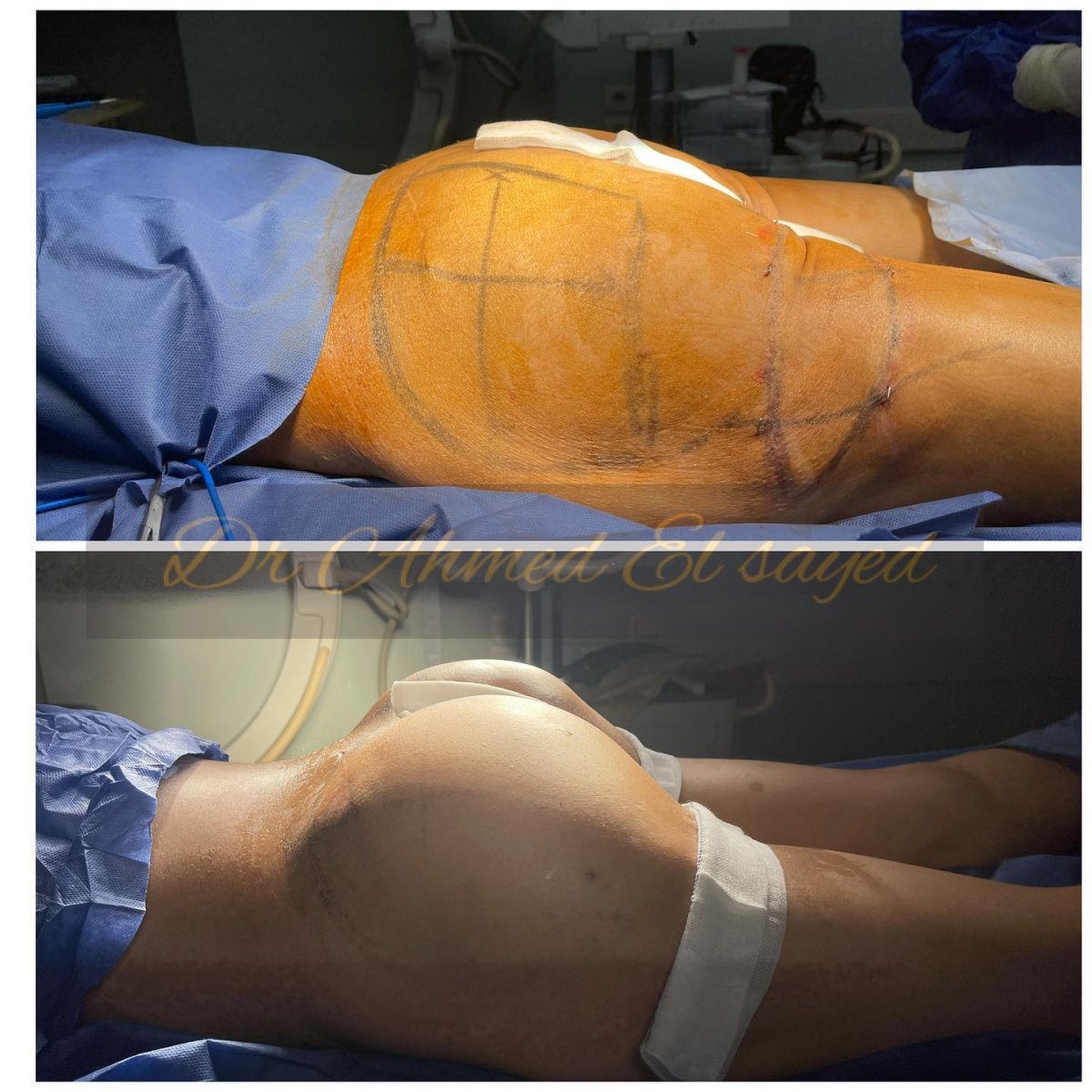 Результаты до и после Brazilian Butt Lift – улучшенный контур ягодиц после процедуры