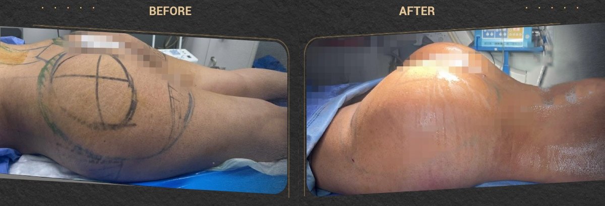 Результаты до и после Brazilian Butt Lift – улучшенный контур ягодиц после процедуры