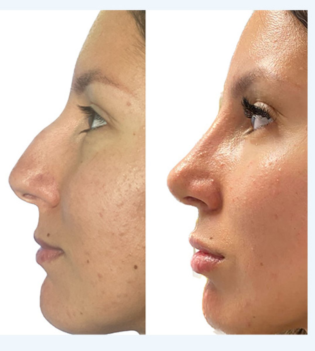 Résultats avant et après rhinoplastie, remodelage du nez et profil amélioré chez une femme