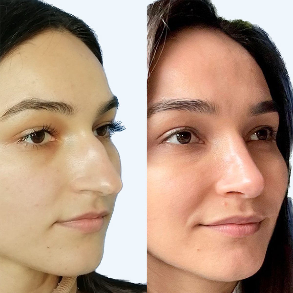 نتائج عملية تجميل الأنف قبل وبعد، إعادة تشكيل الأنف بمظهر طبيعي