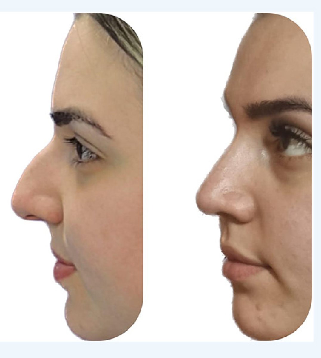 نتائج عملية تجميل الأنف قبل وبعد، إعادة تشكيل الأنف وتحسين المظهر الجانبي