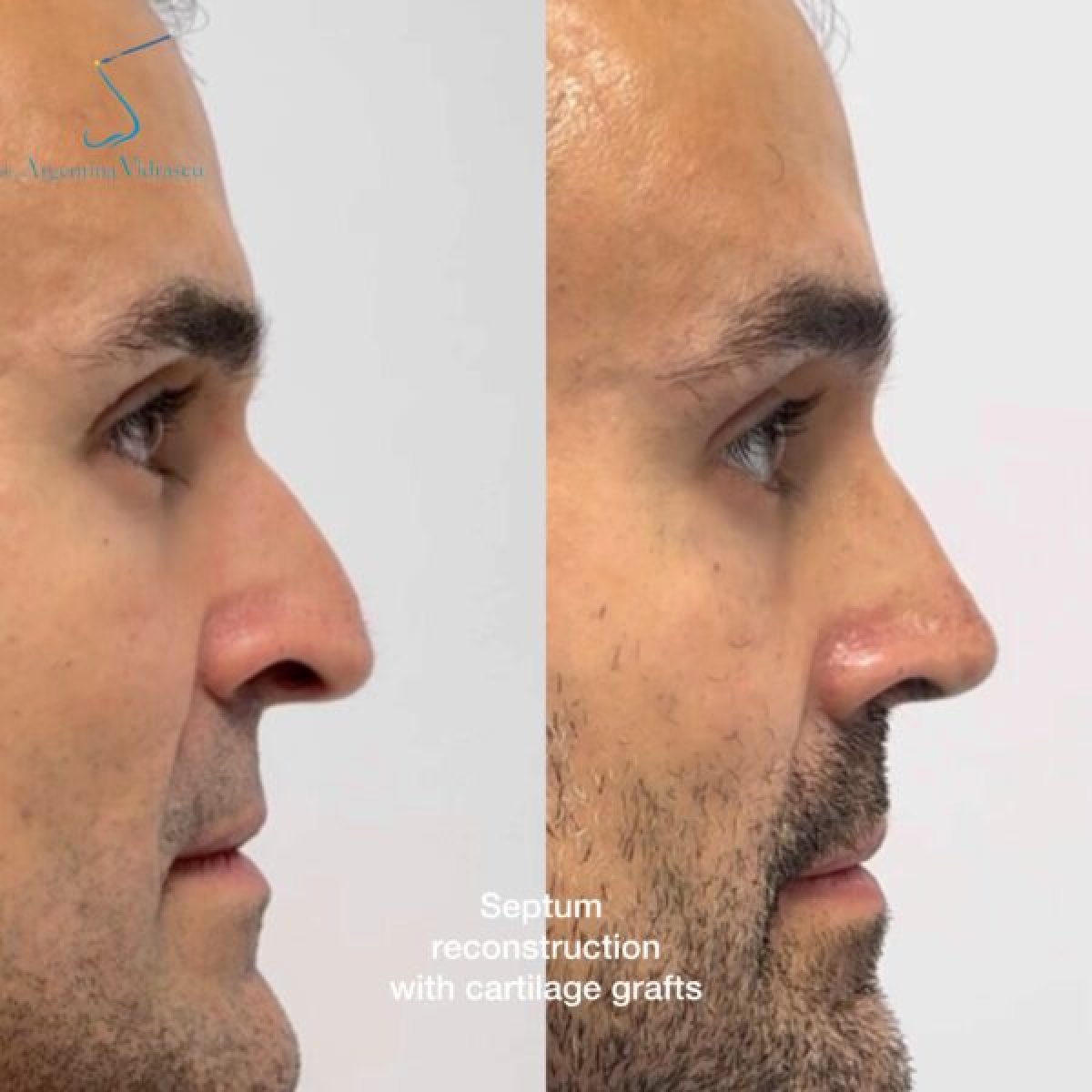 Résultat avant/après septoplastie avec greffes de cartilage, profil nasal amélioré