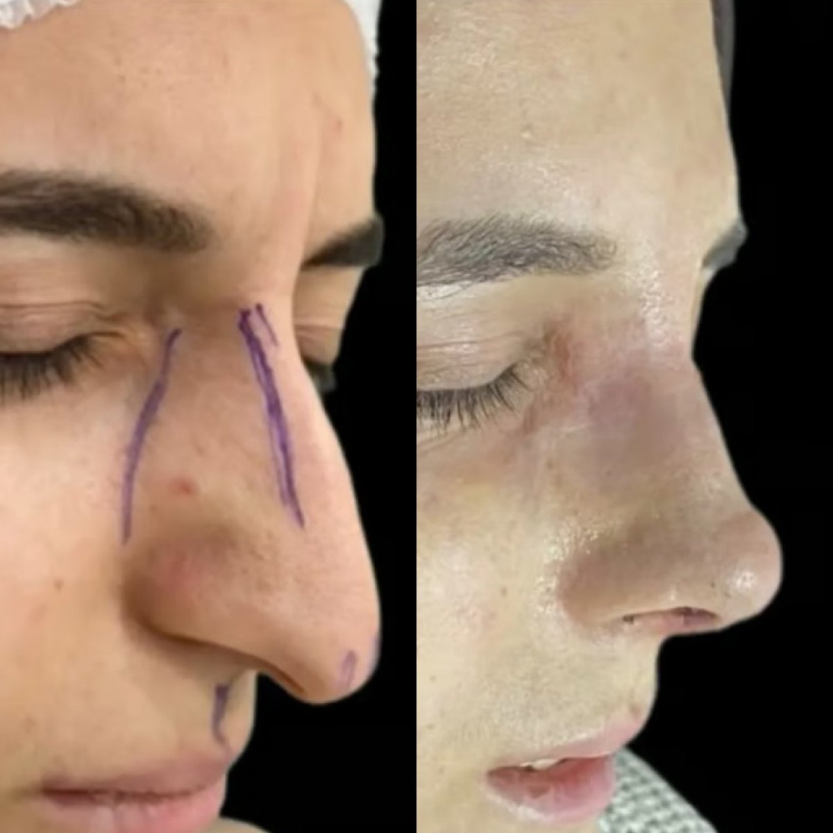 نتائج تجميل الأنف قبل وبعد في عيادة ألتان تكين، تحسين شكل الأنف وتناسقه