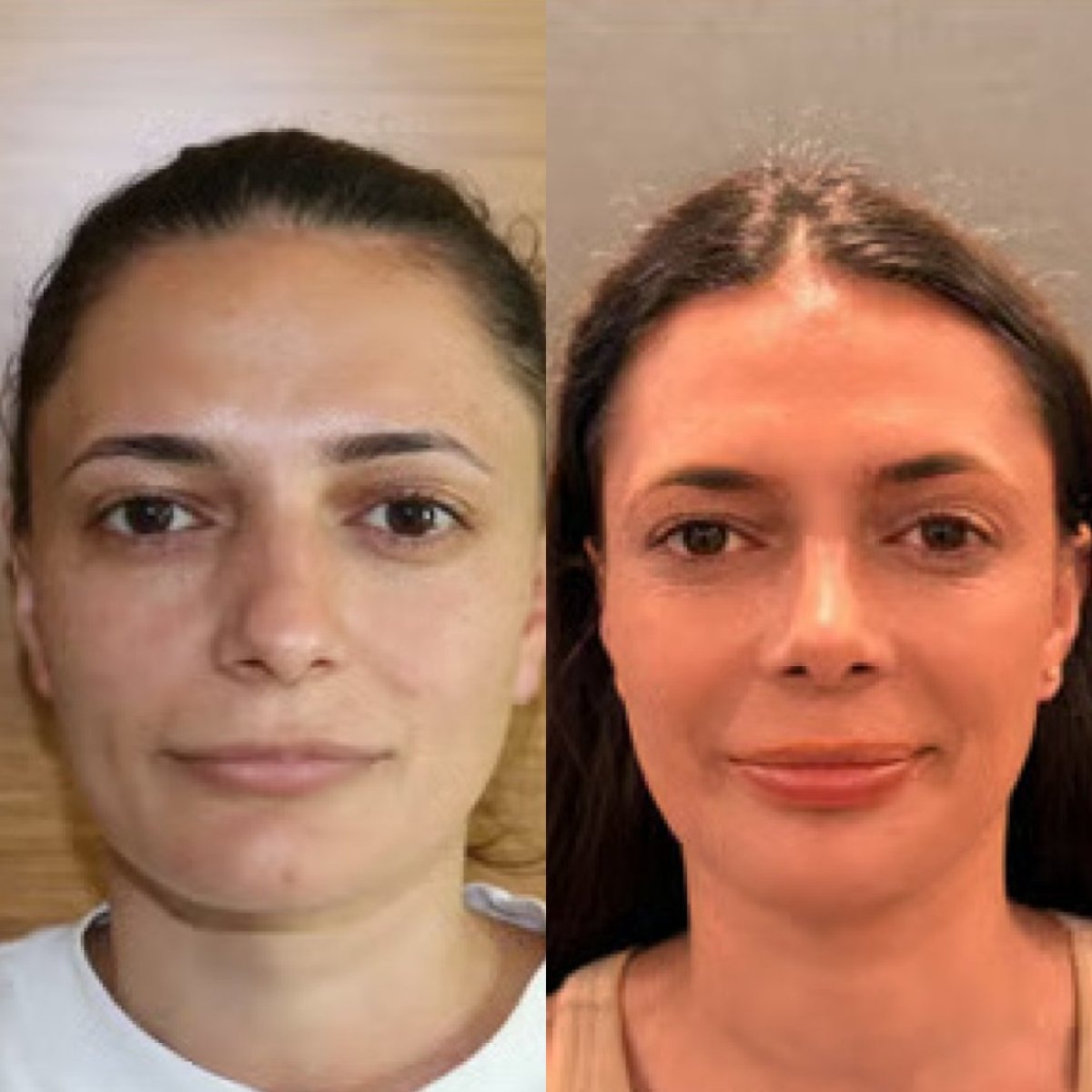 نتائج عملية تجميل الأنف قبل وبعد في عيادة ألتان تكين، إعادة تشكيل وتحسين الأنف