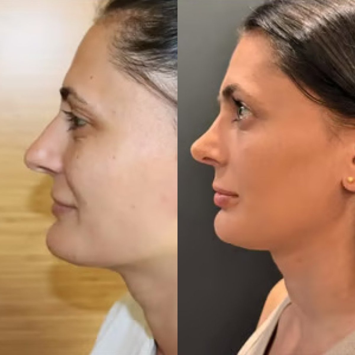 نتائج عملية تجميل الأنف قبل وبعد في عيادة ألتان تكين، تحسين شكل الأنف
