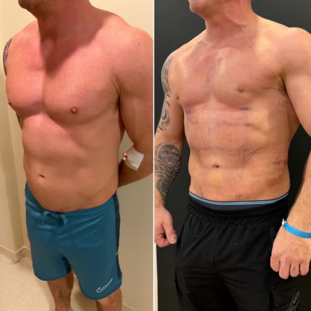 Before and after tummy tuck results at Altan Tekin Clinic, visible abdominal contouring