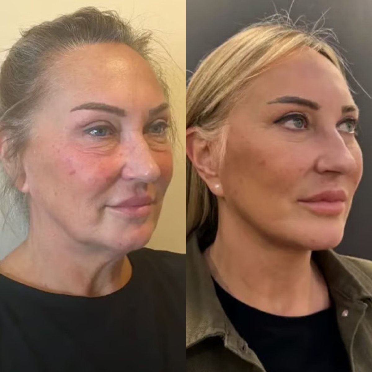 Résultats avant et après lifting du visage à la clinique Altan Tekin, rajeunissement visible