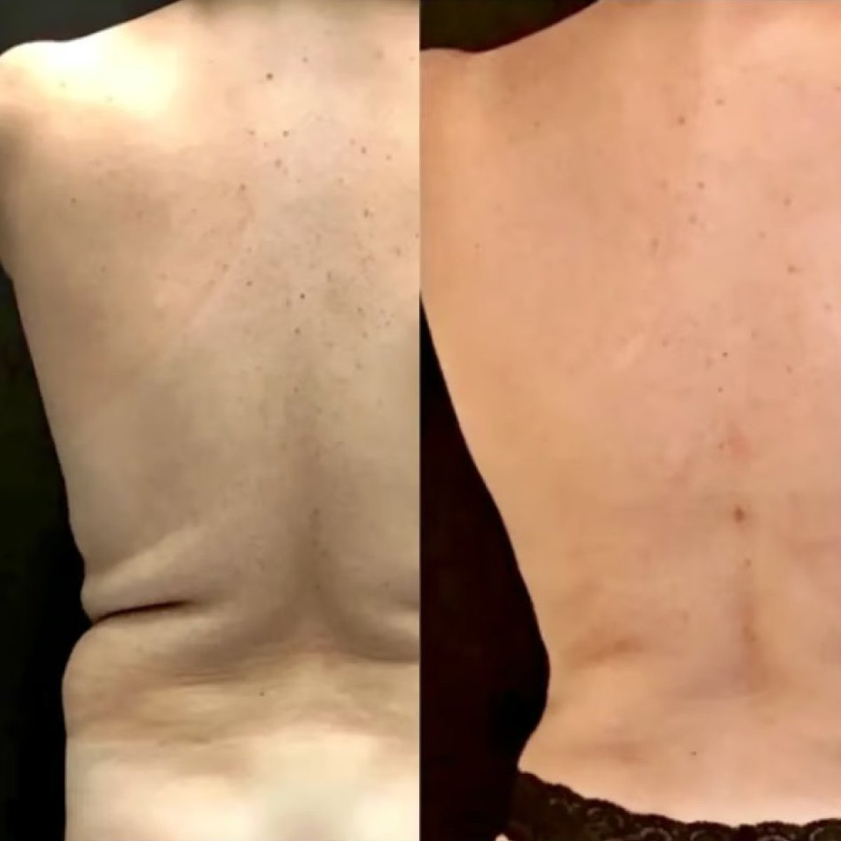 Vorher-nachher-Ergebnis der Rückenliposuktion in der Altan Tekin Clinic, bessere Kontur