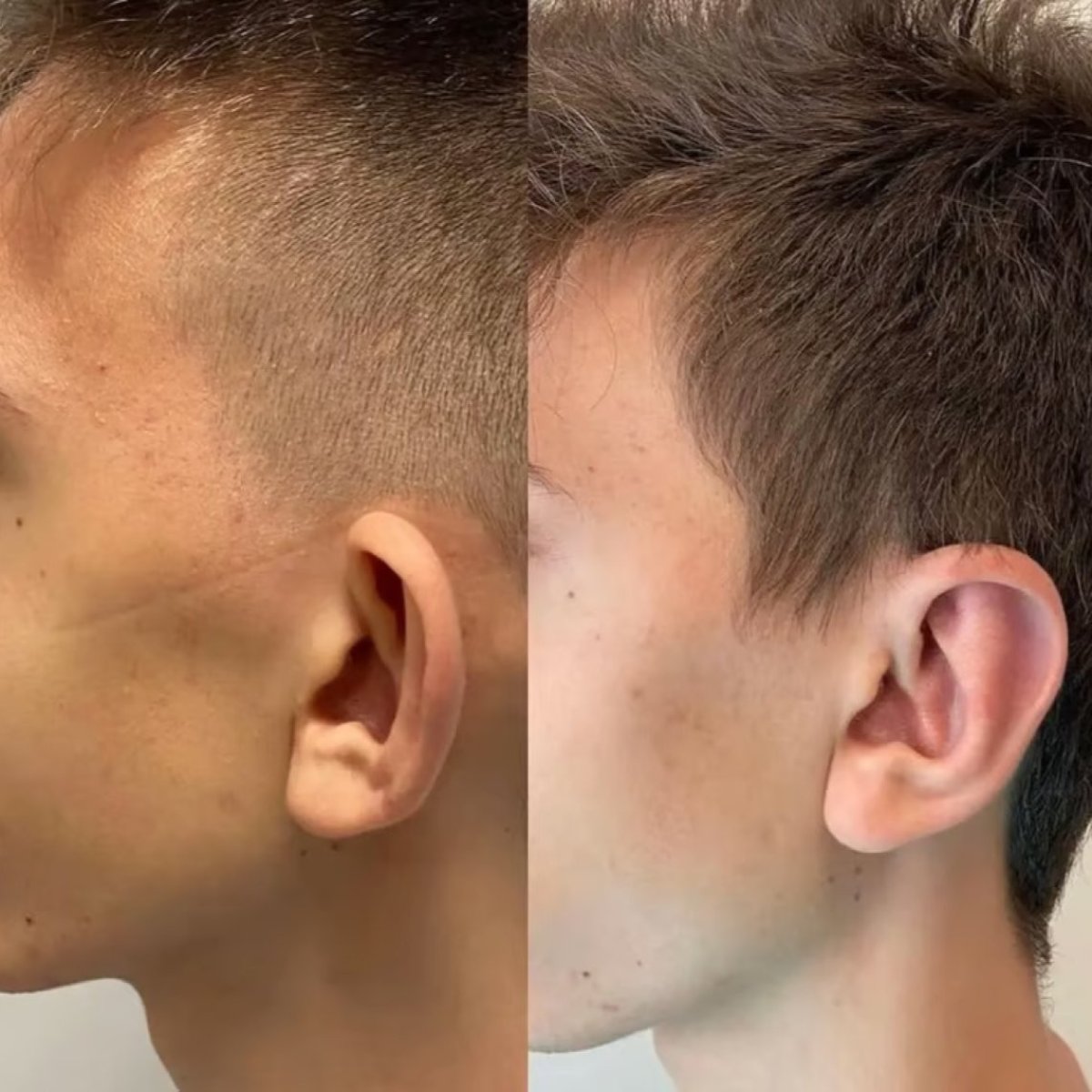 نتائج تجميل الأذن قبل وبعد في عيادة ألتان تكين، تحسين شكل الأذن