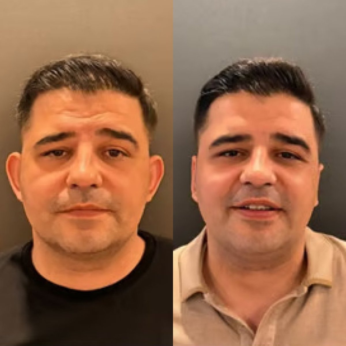 Résultats avant/après otoplastie à la clinique Altan Tekin, forme des oreilles améliorée