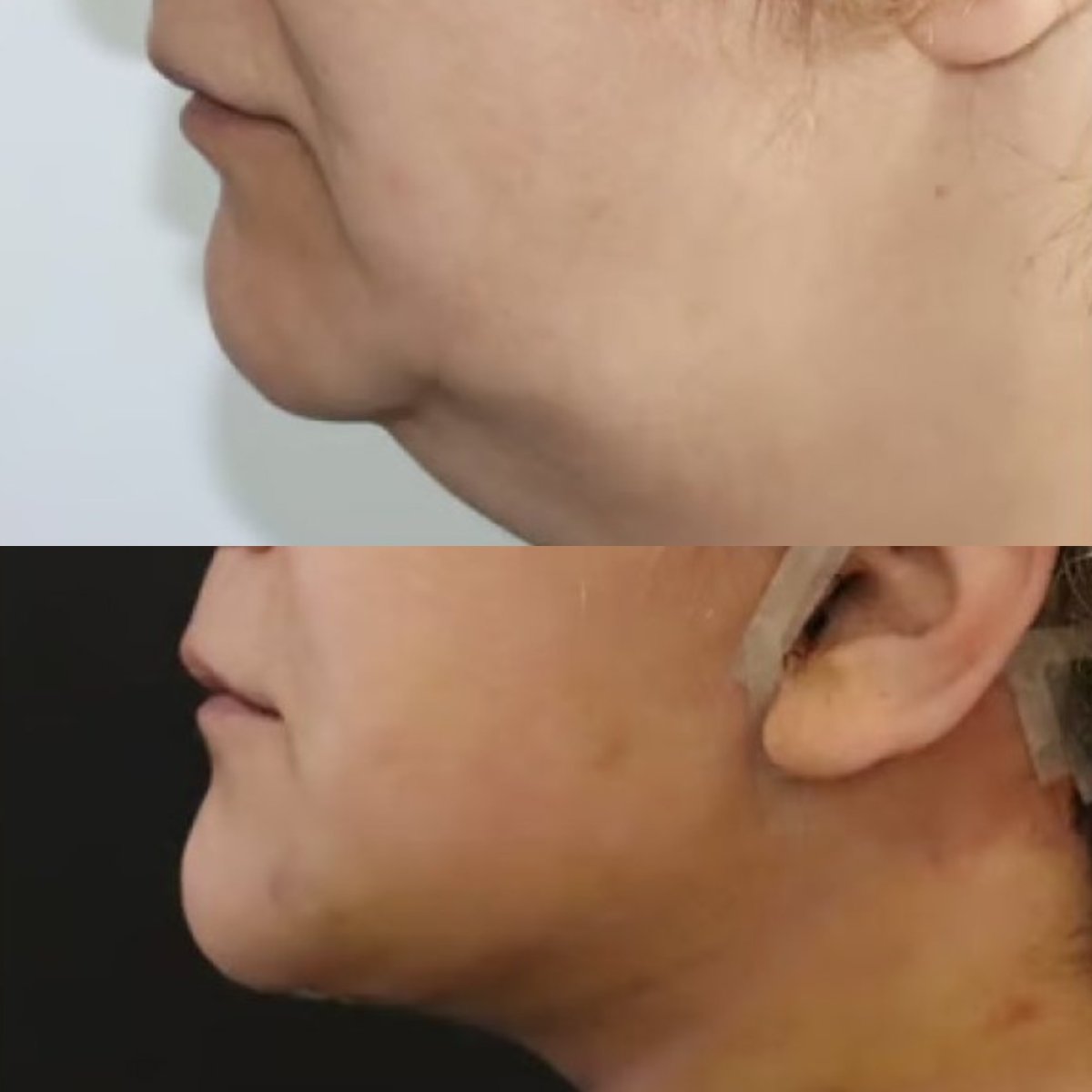Before and after neck lift results at Altan Tekin Clinic, improved jawline and neck contour