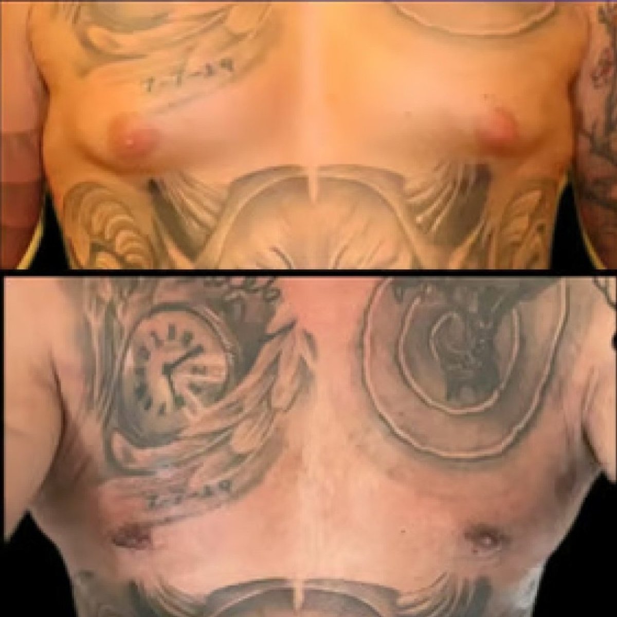Before and after gynecomastia surgery results at Altan Tekin Clinic, male chest contouring