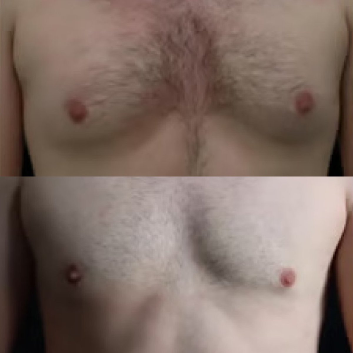 Before and after gynecomastia surgery results at Altan Tekin Clinic, improved chest contour