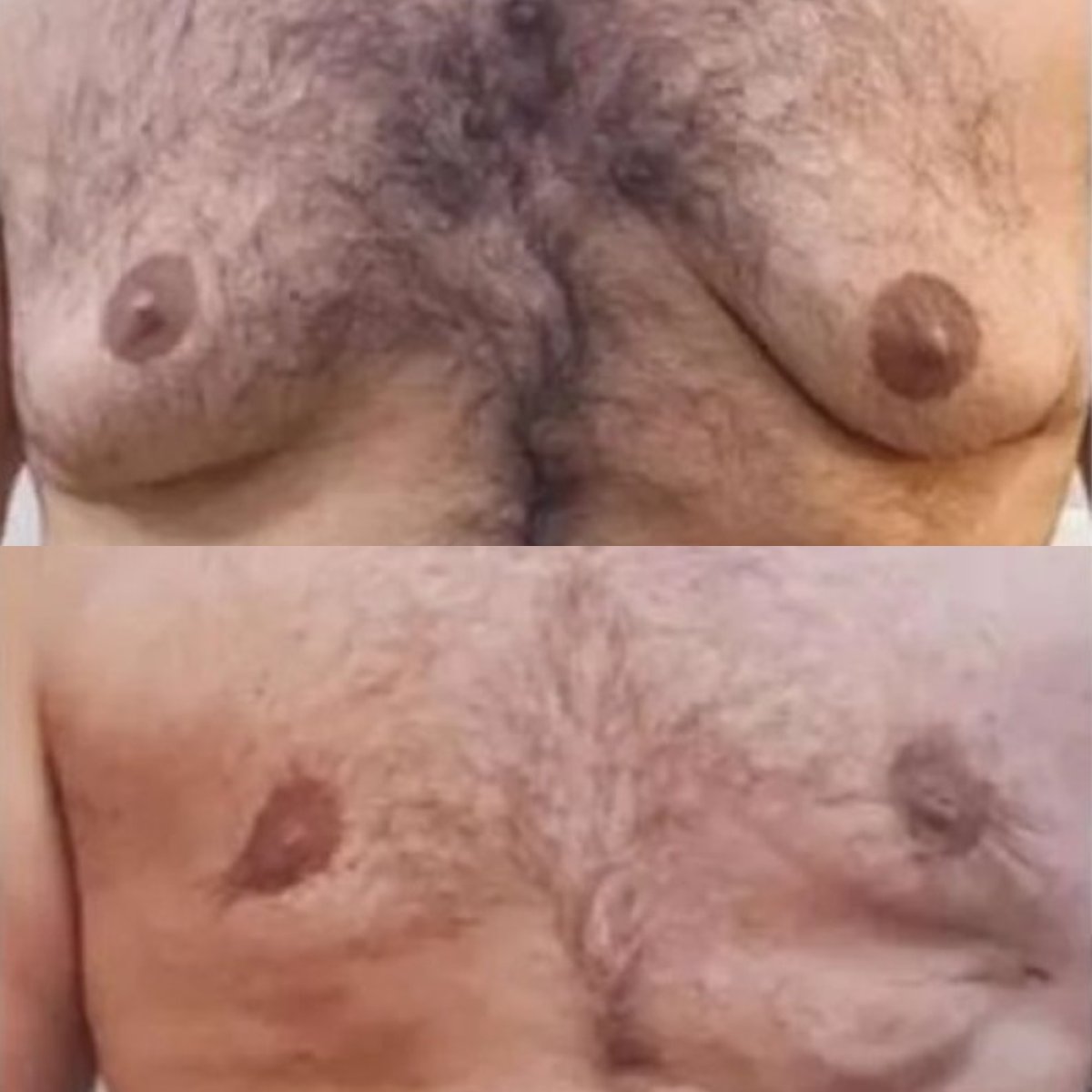 نتائج قبل وبعد جراحة التثدي في عيادة ElGamal، تحسين شكل صدر الرجل