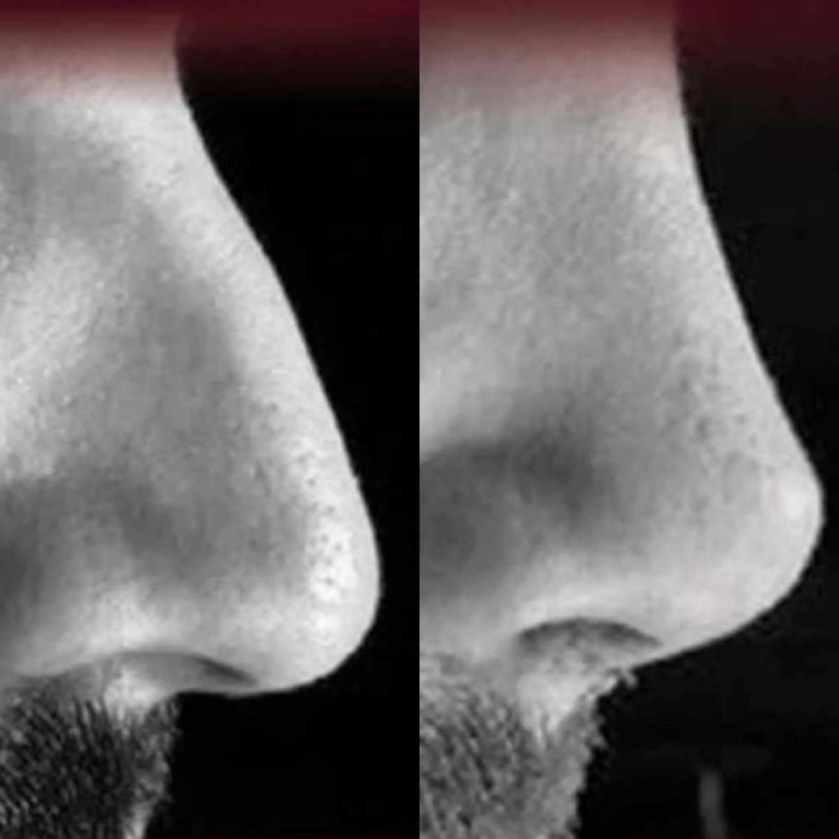 Before and after rhinoplasty results at ElGamal Clinic, improved nose shape and profile