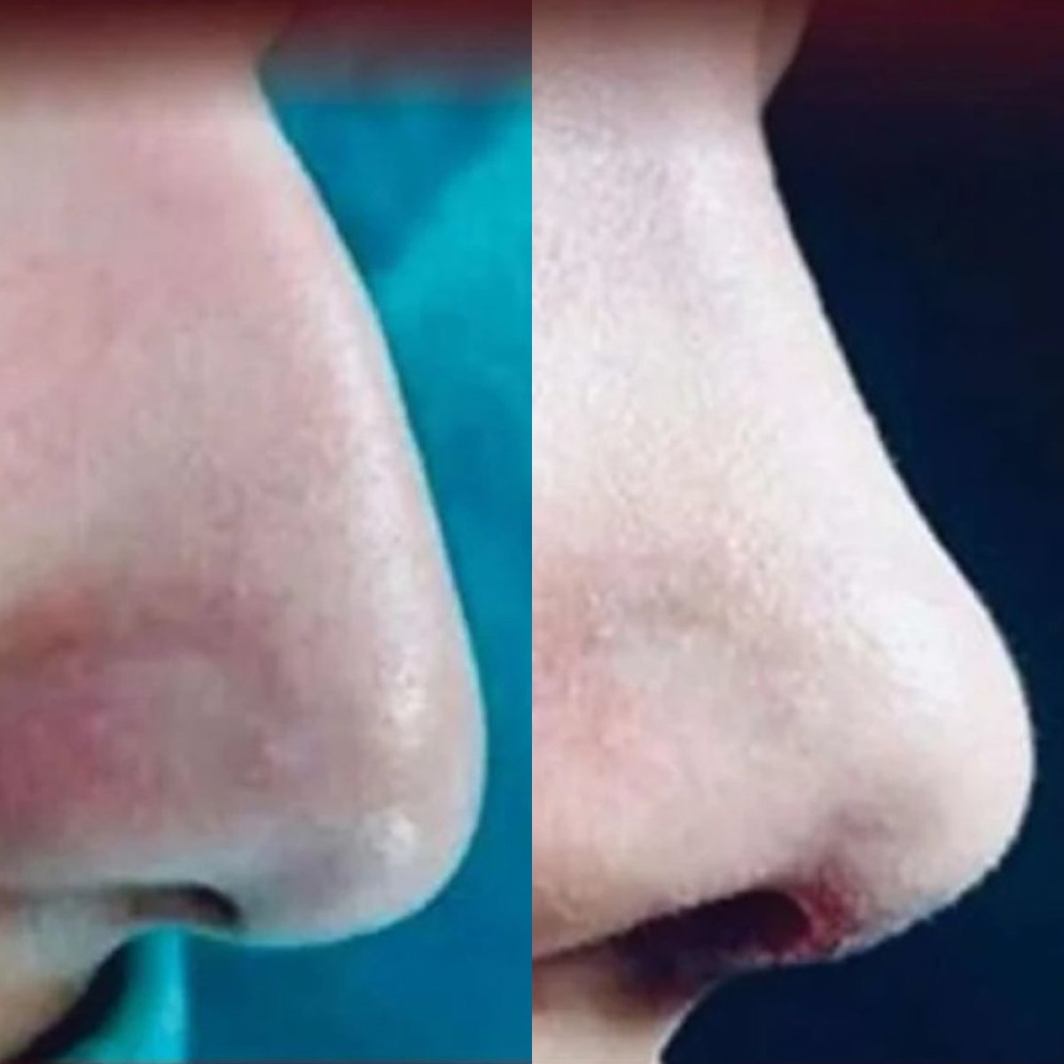 نتائج تجميل الأنف قبل وبعد في عيادة ElGamal، إعادة تشكيل الأنف بمظهر طبيعي