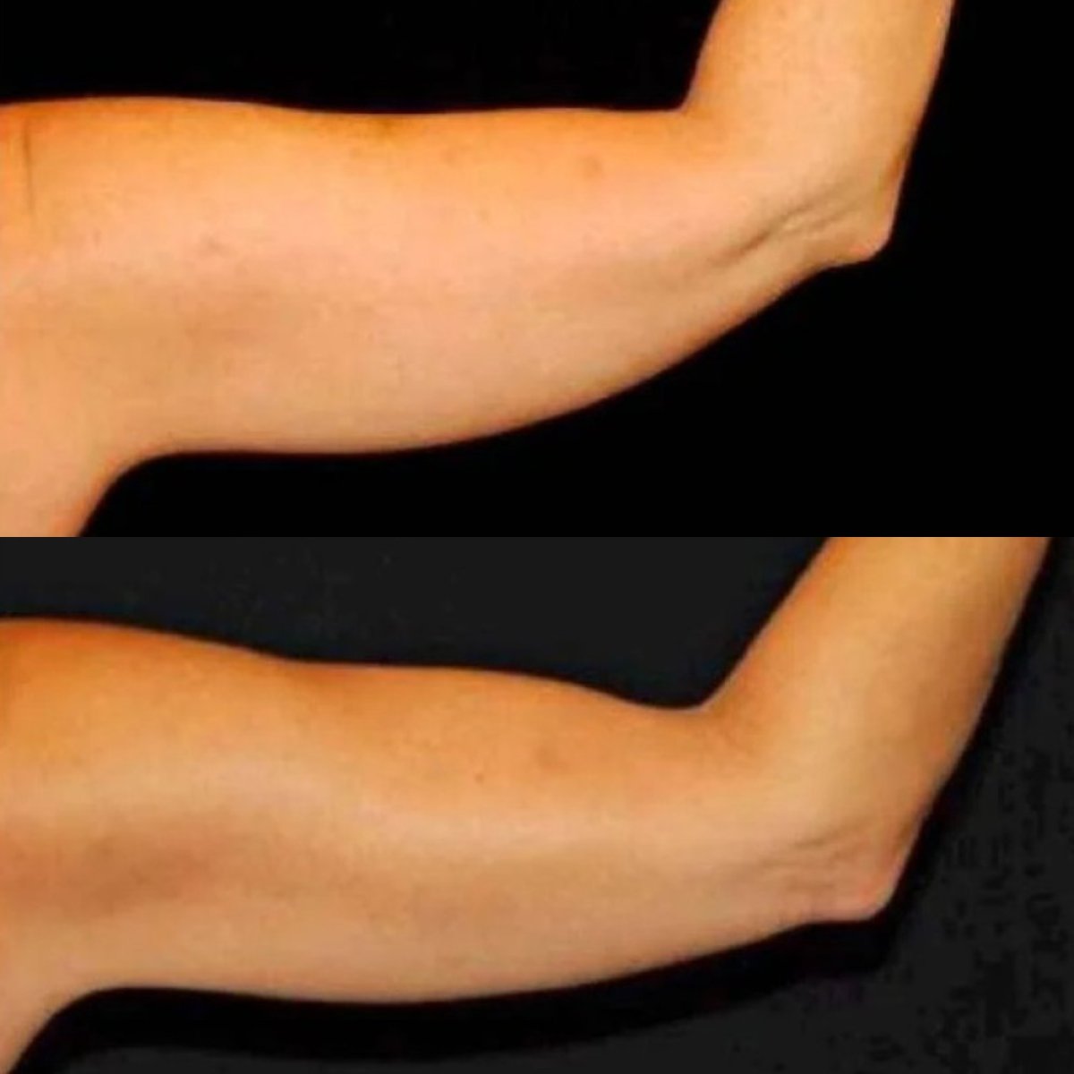 Before and after arm lift (brachioplasty) results at ElGamal Clinic – improved arm contour