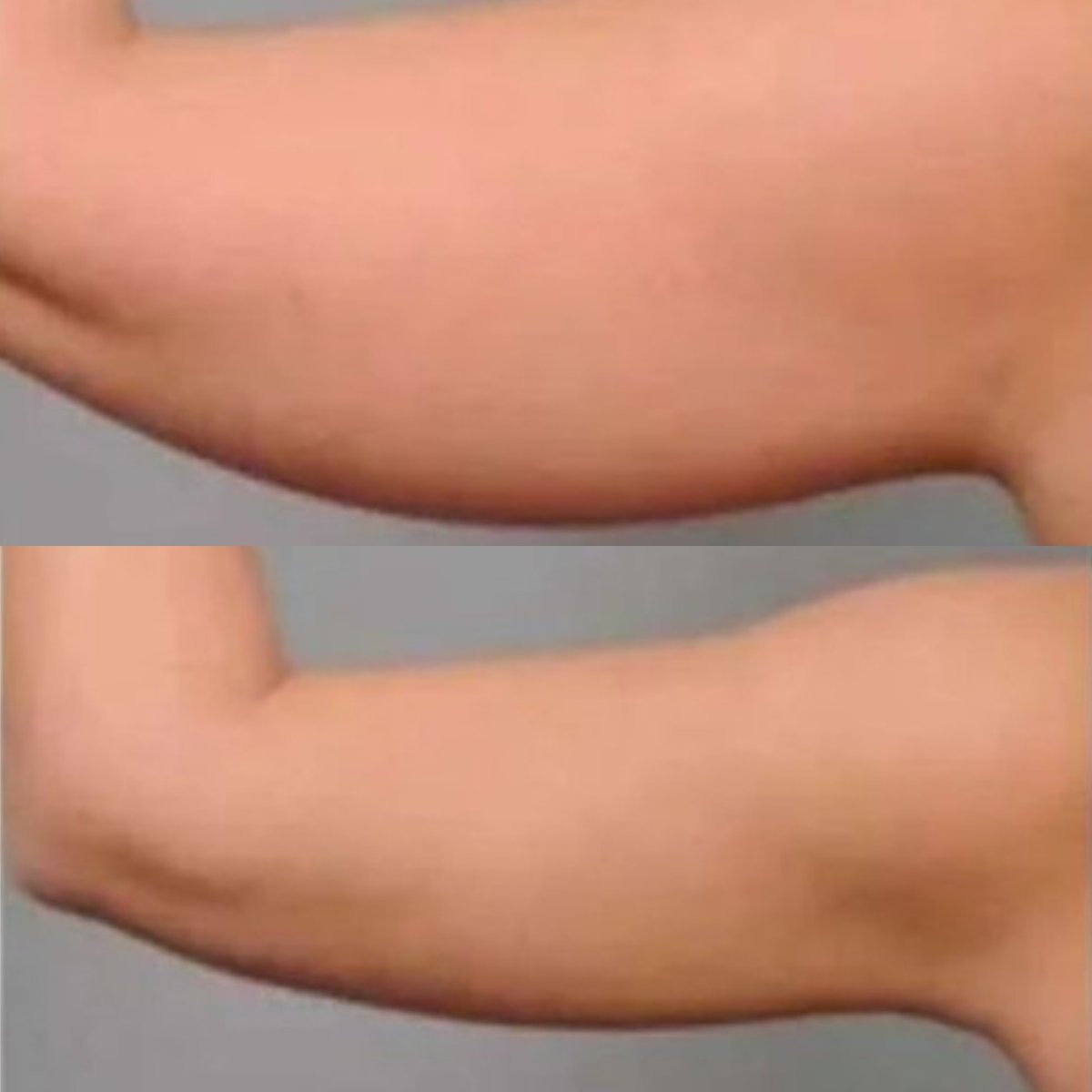 Before and after arm lift (brachioplasty) results at ElGamal Clinic, improved arm contour