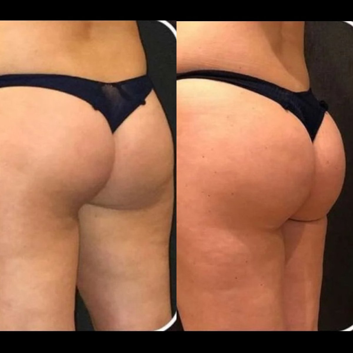 Before and after Brazilian Butt Lift results at ElGamal Clinic, enhanced buttock contour