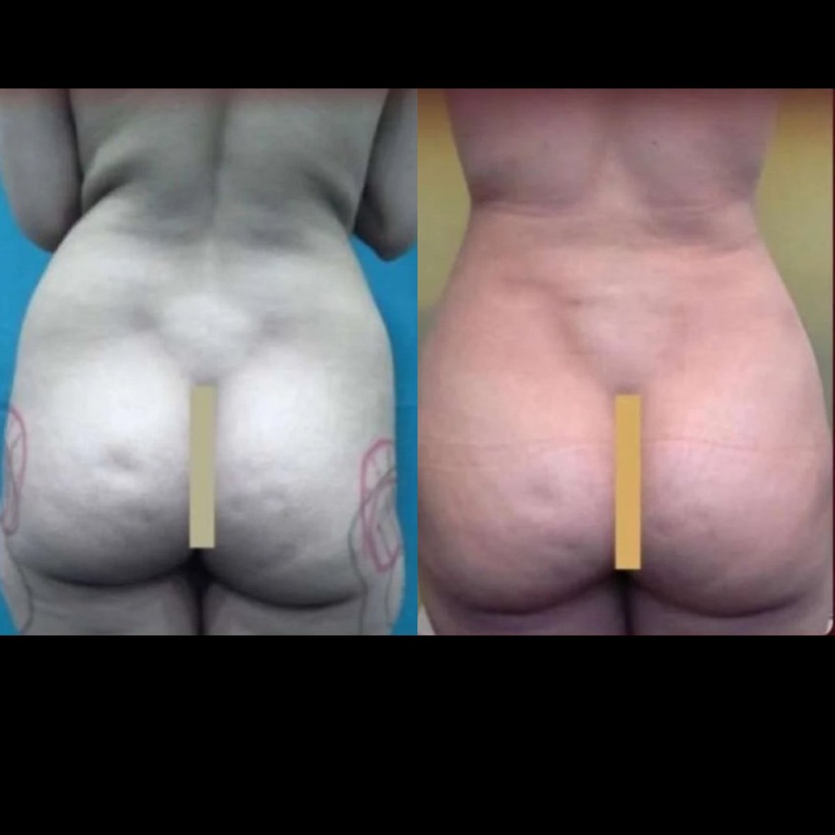 نتائج قبل وبعد عملية Brazilian Butt Lift في عيادة ElGamal، تحسين شكل الأرداف