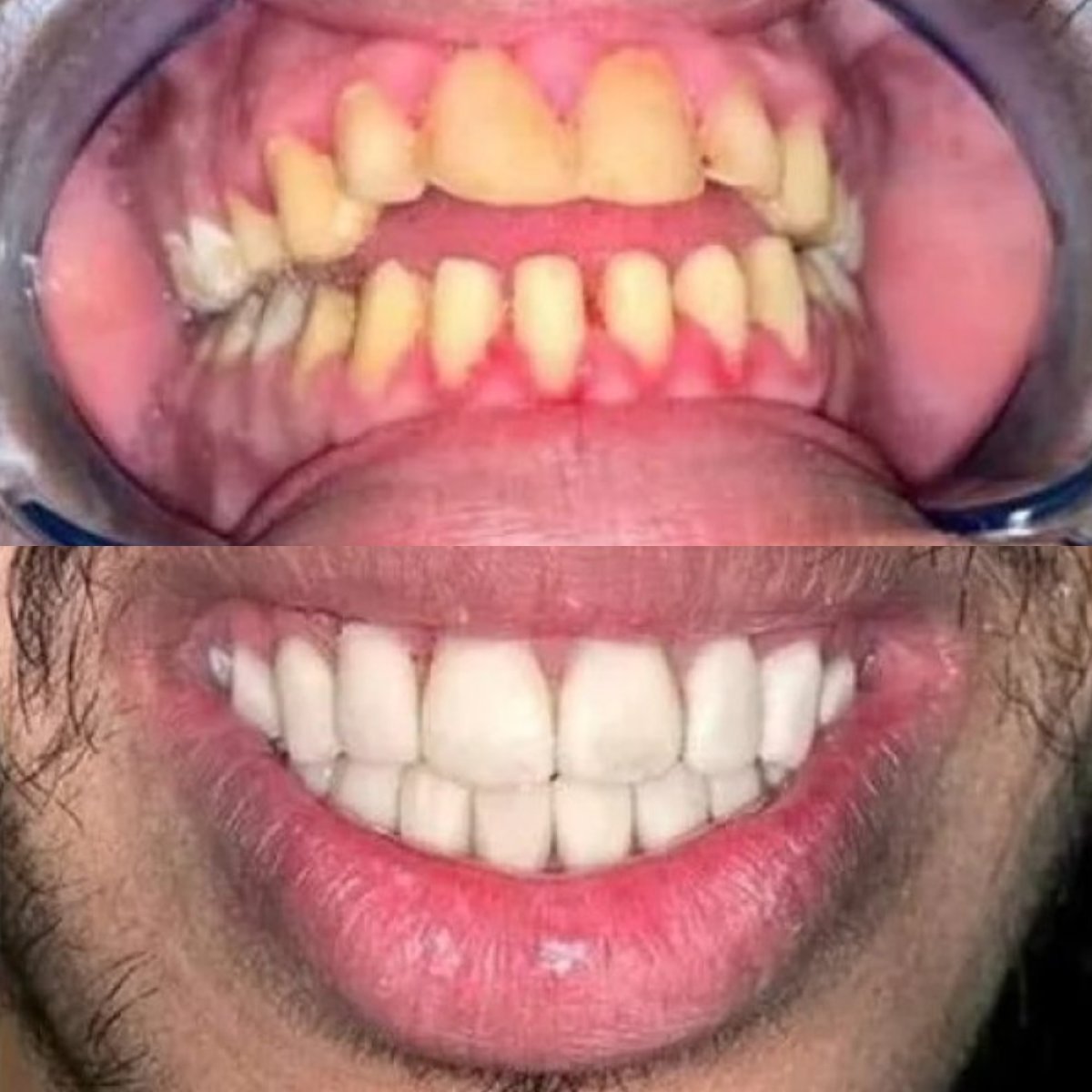 Resultados de carillas de porcelana antes y después en ElGamal Clinic – transformación de sonrisa