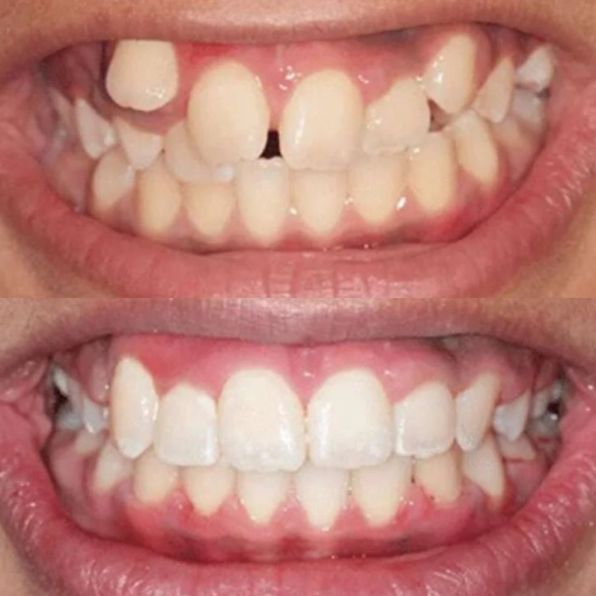 Before and after Invisalign results at ElGamal Clinic – straighter teeth and improved smile