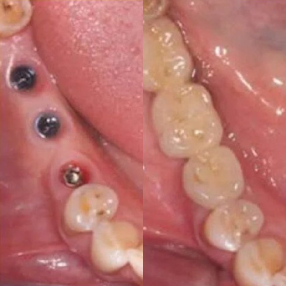 Resultados antes y después de implante dental con corona en ElGamal Clinic, molares restaurados